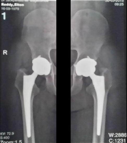Bilateral Hip Replacement (2).jpg