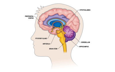 What Are Cluster Headaches?